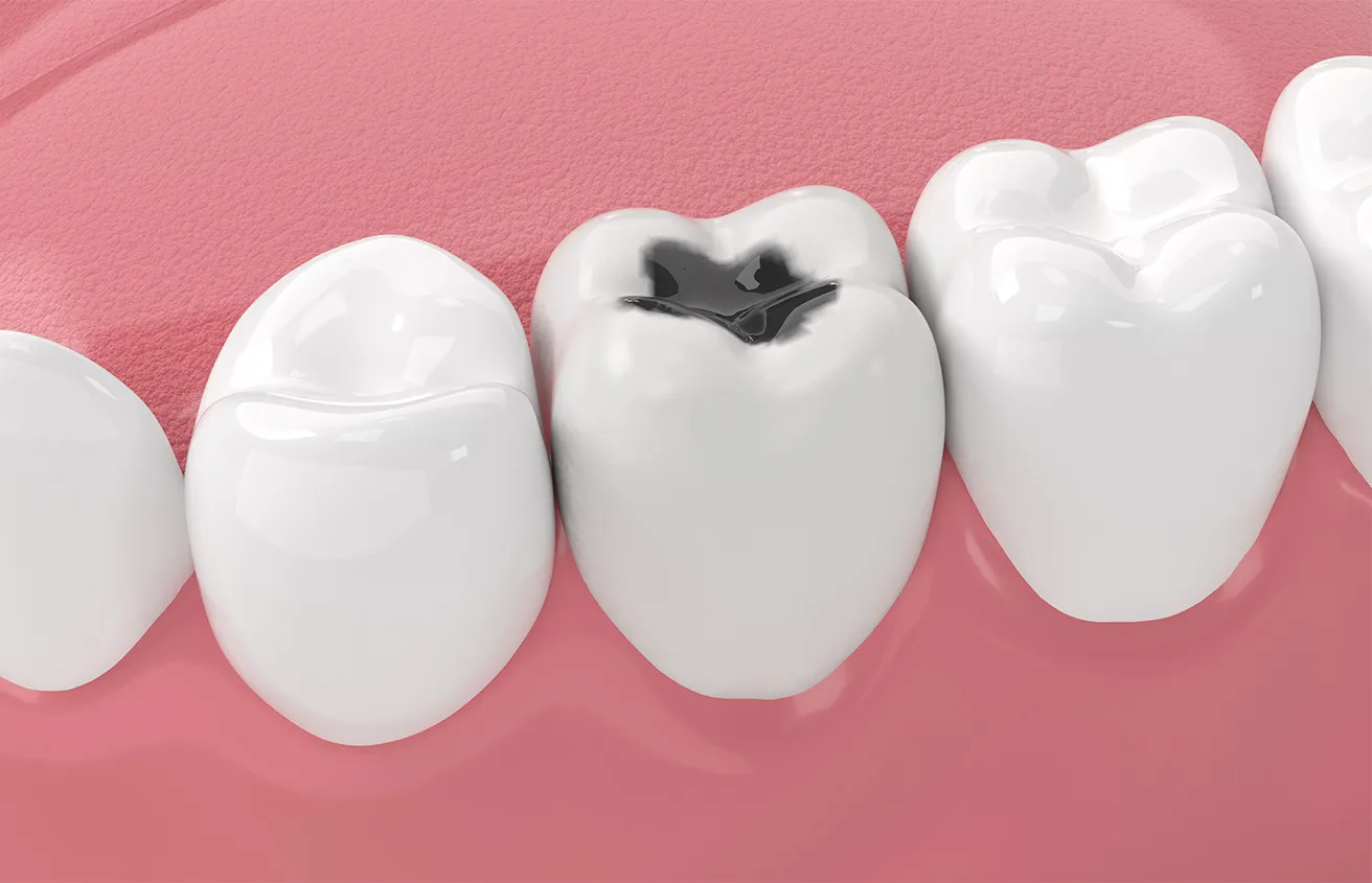 Dental Filling Problems